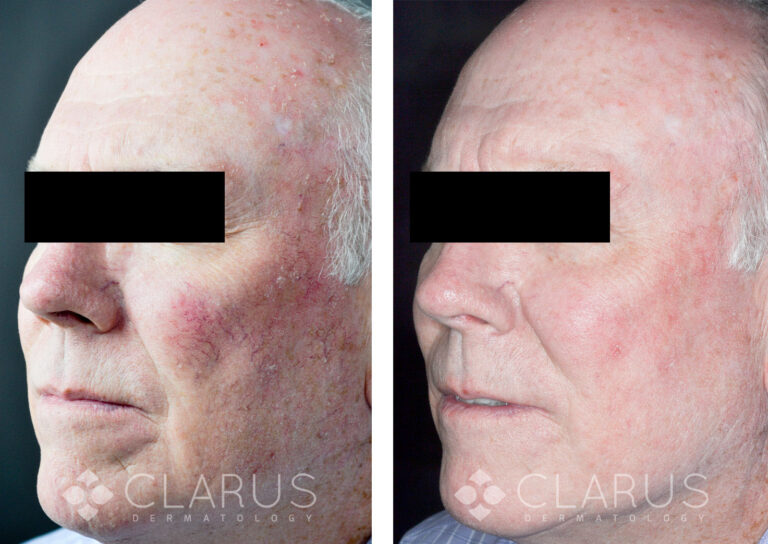 Rosacea Treatment