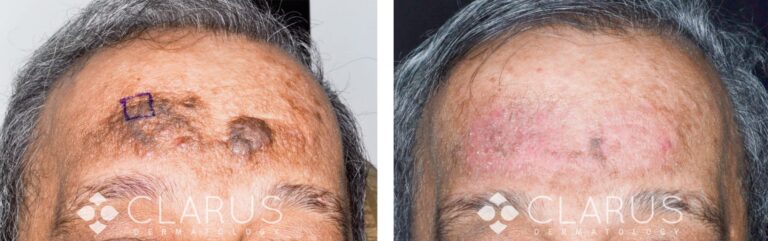 Rosacea and Phymatous Treatment