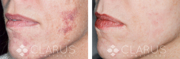 Birthmark Treatment
