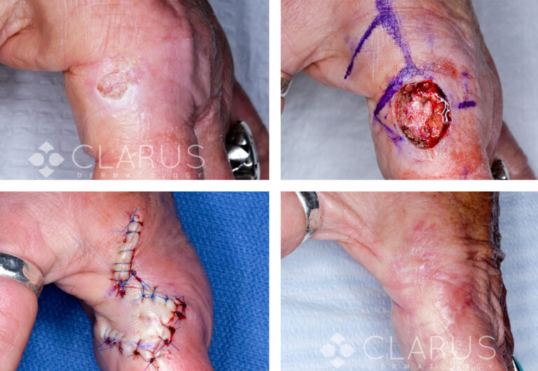 Mohs Surgery - Temple SCC