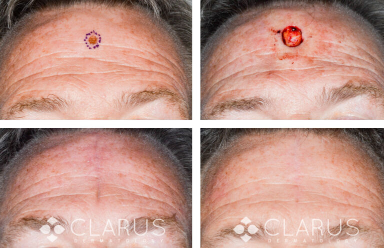 Mohs Surgery - Finger SCC