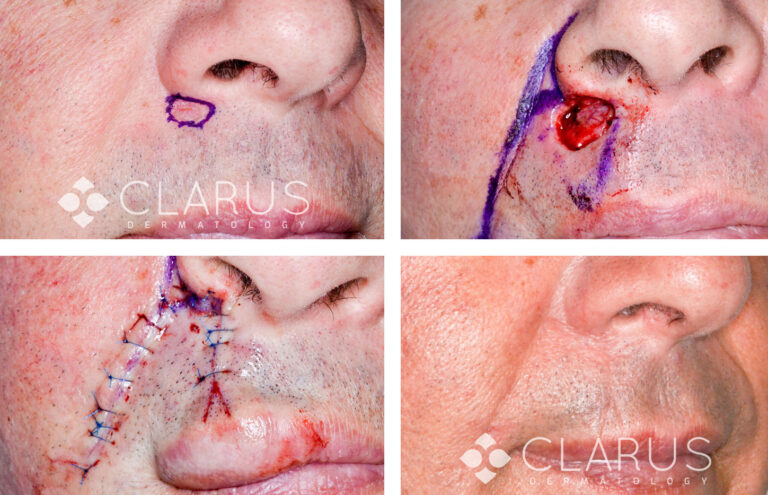 Mohs Surgery - Forehead BCC