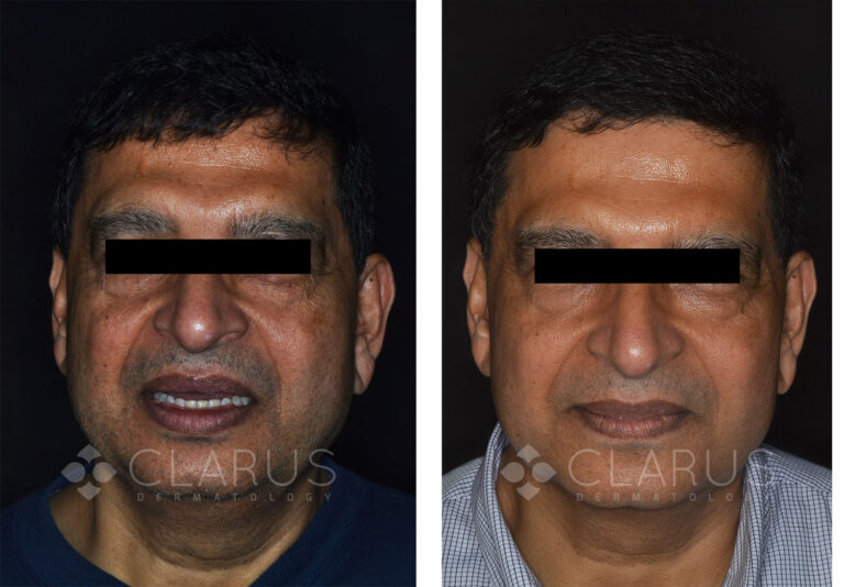 Multi-Treatments for Aging and Sun Damage 2
