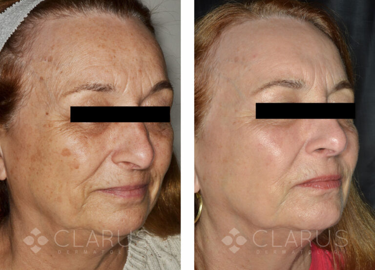 Multi-Treatments for Aging and Sun Damage