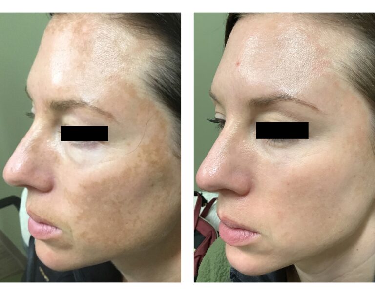 Medium Depth Chemical Peel