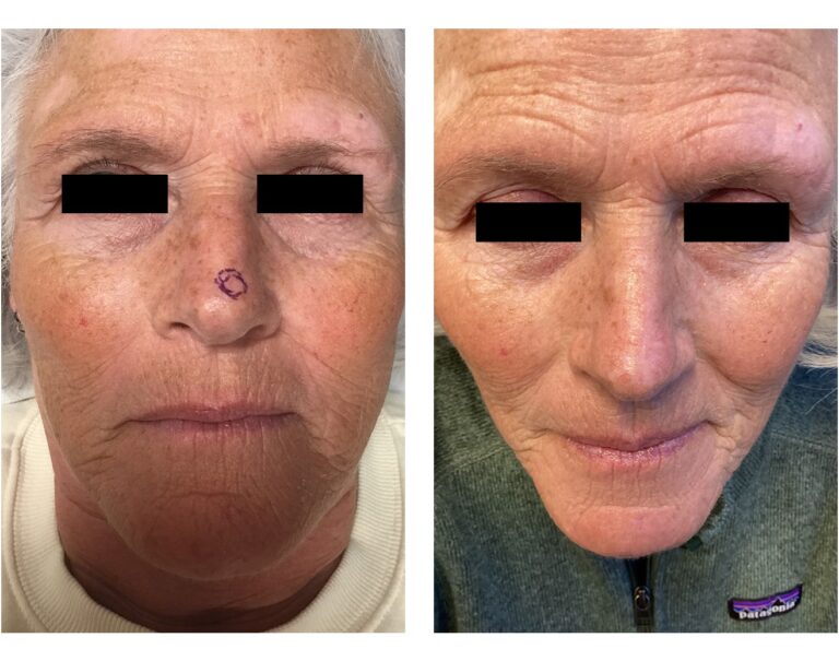 Mohs Surgery - Nasal Dorsum