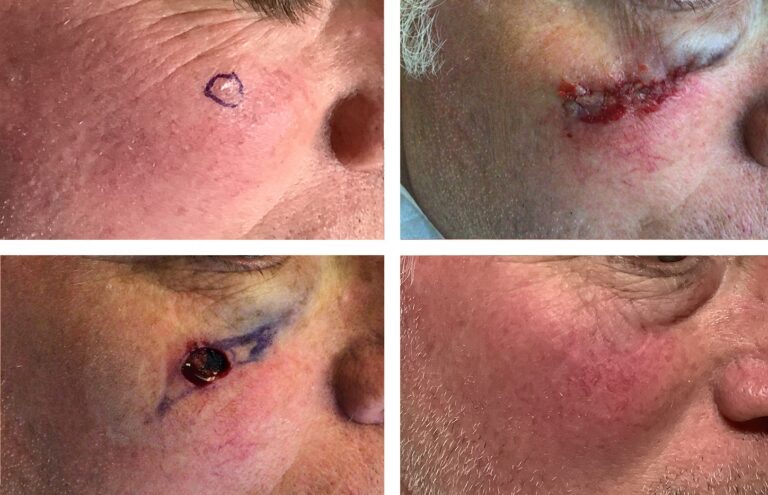 Keloid Tumor Excision
